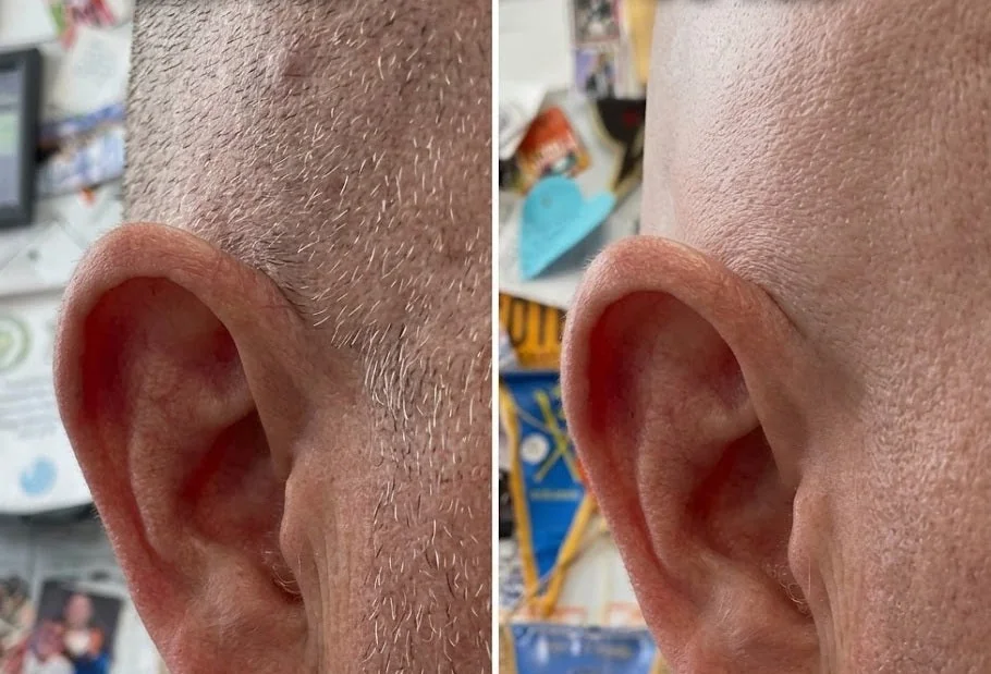 Before and after using the Exoshave 7D